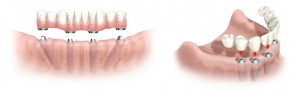 Стоматология во Всеволожске «Медотель» предлагает протезирование зубов несъемными протезами