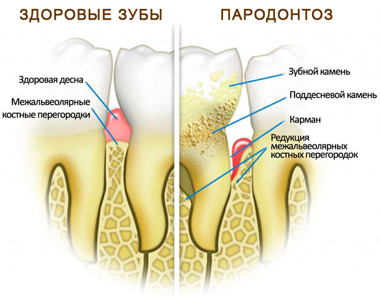 parodontoz