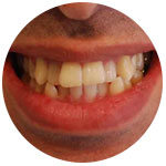 Передние зубы имеют неровности 