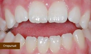 зубы полностью или частично не смыкаются