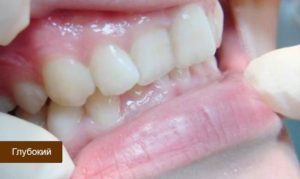 резцы верхнего ряда наполовину прикрывают нижние, из-за быстрой истираемости эмали это может привести к скорой потере зубов