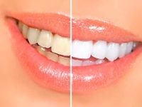 Врачи стоматологии во Всеволожске рассказывают про отбеливание зубов с помощью перекиси