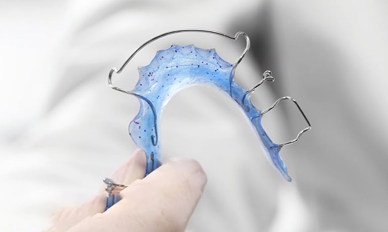 Ортодонтическое лечение пластинками