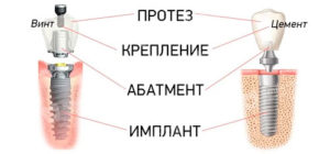 виды крепления имплантов