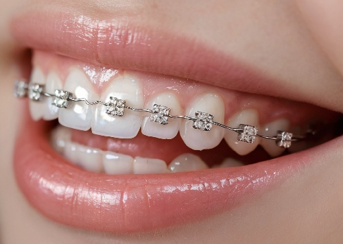 braces (1)